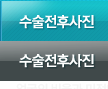 수술전후사진