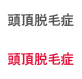 정수리탈모