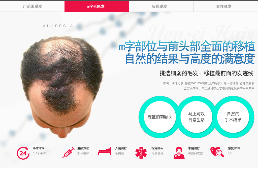 m字形脱发