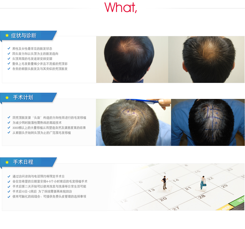 头顶脱发