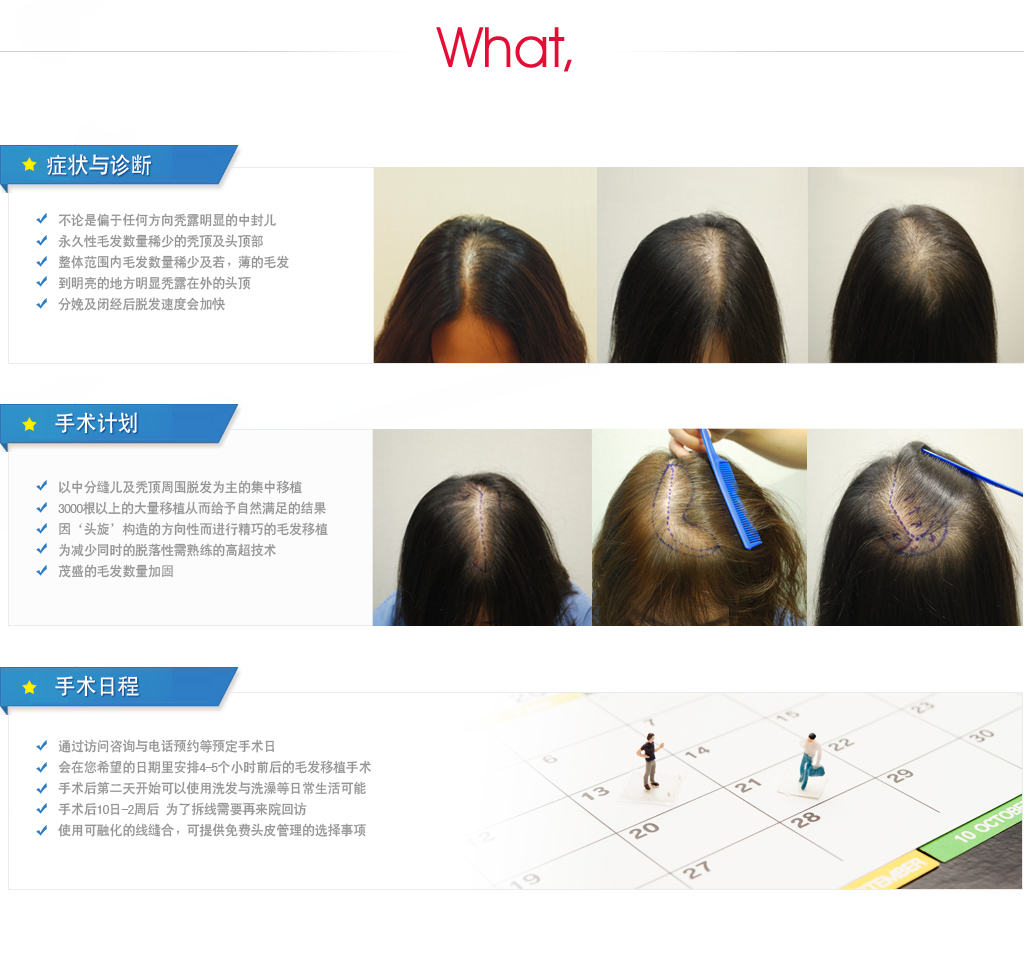 女性脱发