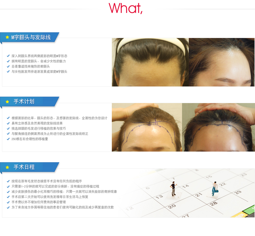 m字发际线
