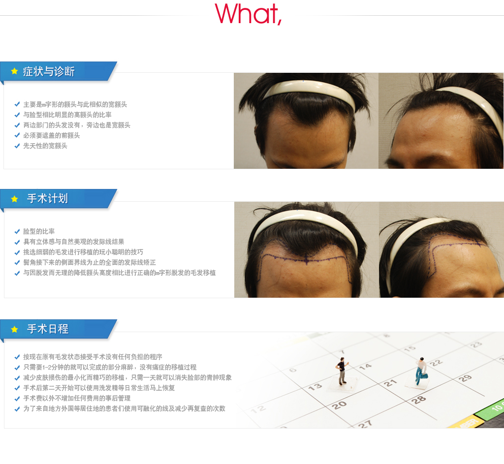男性发际线