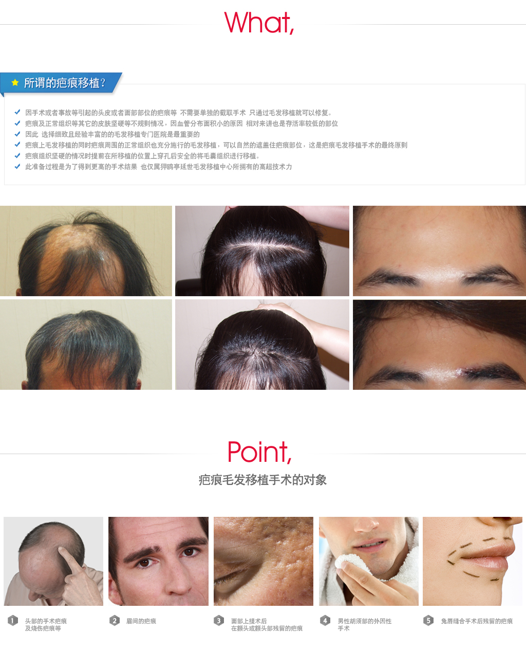 疤痕移植